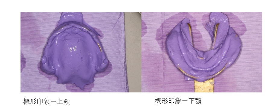 鹿児島　歯医者　義歯