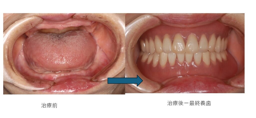 鹿児島　歯医者　義歯