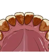 鹿児島　歯医者　着色