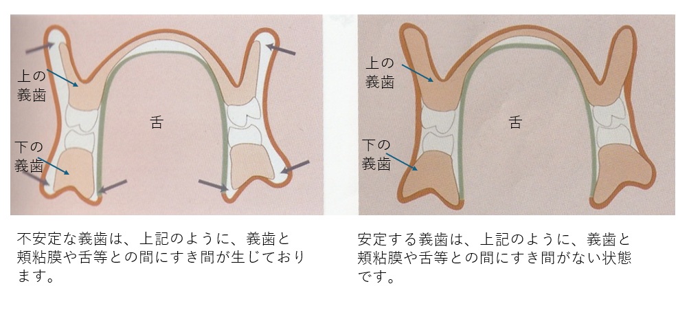 鹿児島　歯医者　義歯安定