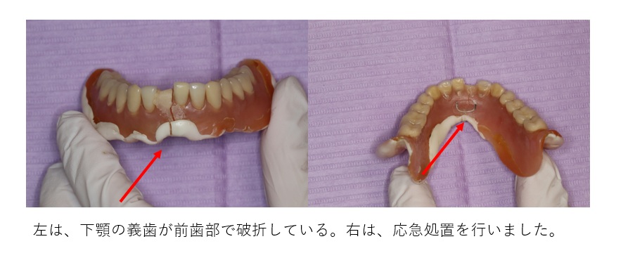 鹿児島　歯医者　義歯破折