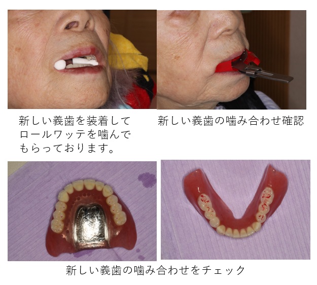 鹿児島　歯医者　義歯