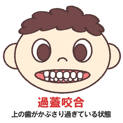 鹿児島　歯医者　クレンチング(くいしばり)→過蓋咬合につながる