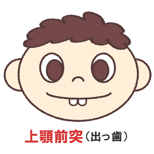 鹿児島　歯医者　口唇癖→上顎前歯の前突