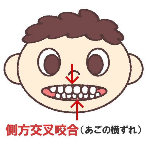 鹿児島　歯医者　偏咀嚼→歯列や顔貌の歪み