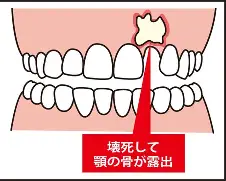 鹿児島 歯医者 骨吸収抑制薬関連顎骨壊死